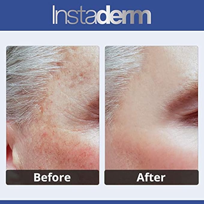 Instaderm ANTI AGING DARK SPOT CORRECTOR CREAM- NATURALLY FADES DARK SPOTS, SUN SPOTS, AGE SPOTS, ACNE BLEMISH SCARS, BROWN SPOTS & FRECKLES FOR BRIGHTER LIGHTER HYDRATED LOOKING SKIN. - Image 3
